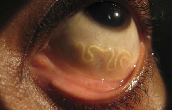 Der Loa-Loa-Wurm lebt im menschlichen Auge und verursacht Blindheit